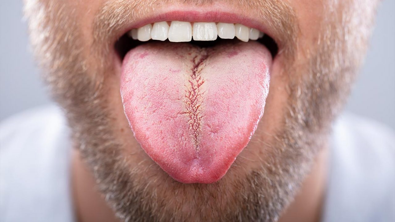 Leucoplachia A Lingua E Bocca Da Cosa Dipende E Come Si Cura